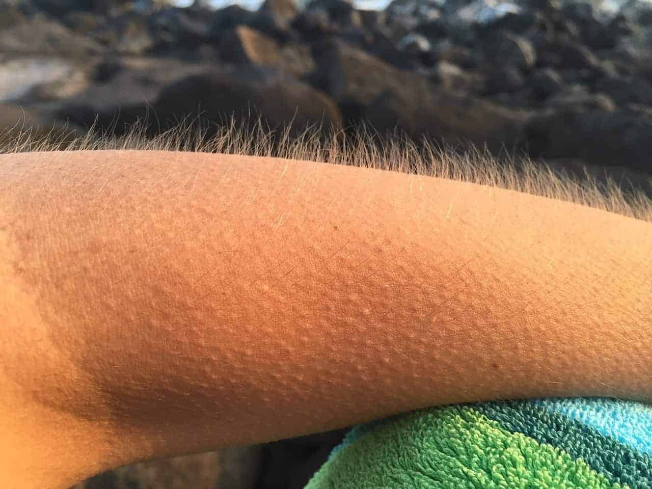 goosebumps arm