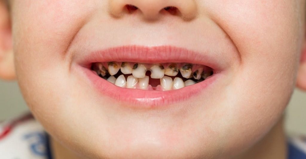 child with rotten teeth