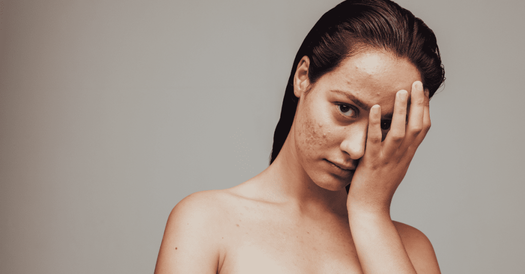 woman with acne covering her face