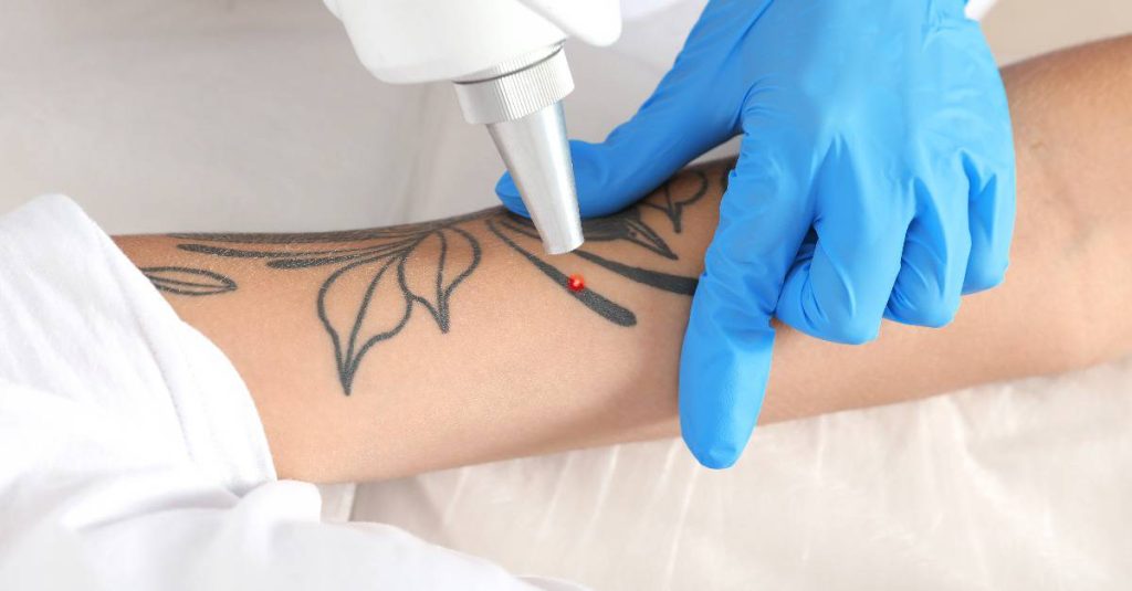 woman getting her tattoo lasered